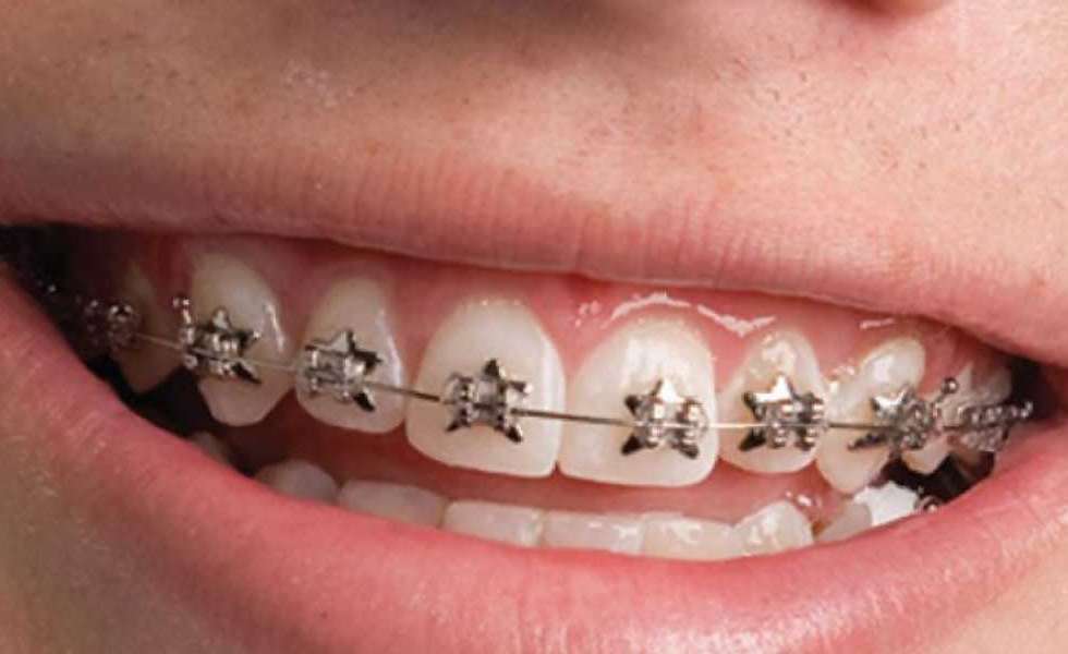 كل ما تريد معرفته حول تكنولوجيا تقويم الاسنان الجديدة - Rident Dental  Centers