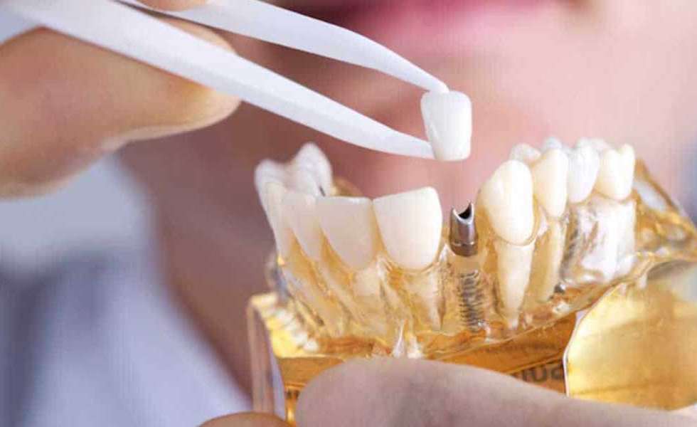 زراعة الاسنان الفورية