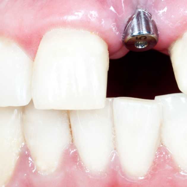 الجراحة في زراعة الأسنان