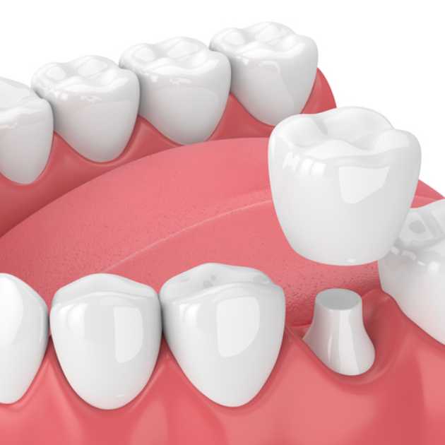 أنواع تركيبات الاسنان