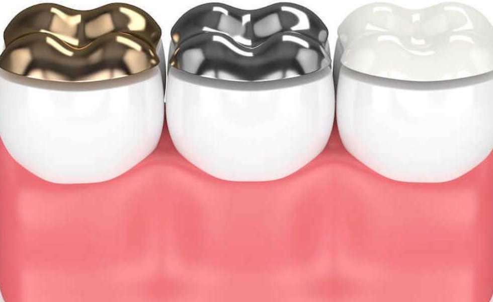انواع طربوش الاسنان