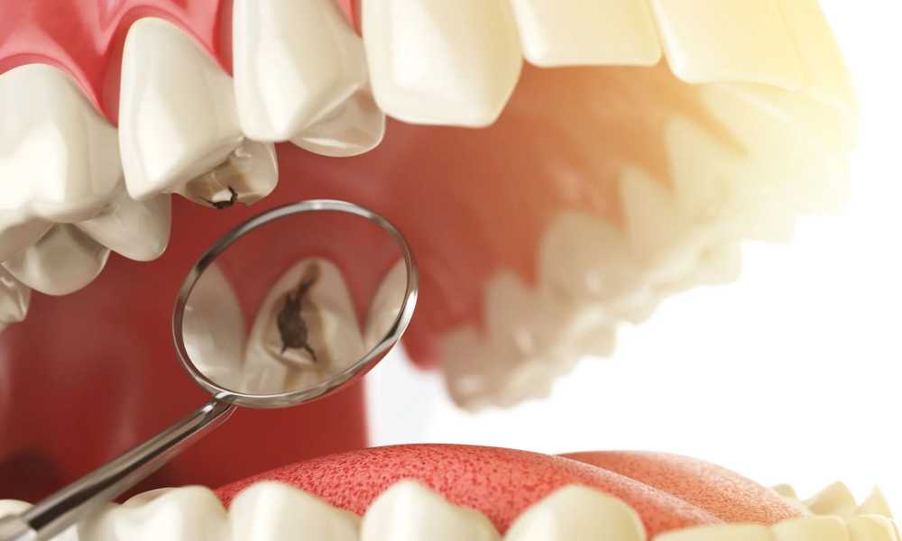 ازاي بيتم علاج العصب فى Rident Dental Centers
