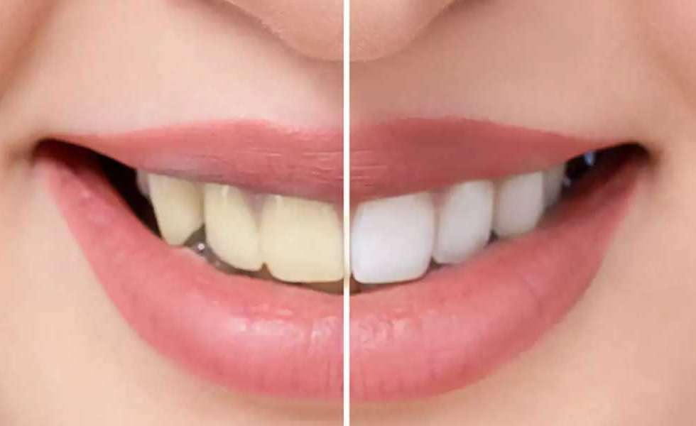 اسباب اصفرار الاسنان