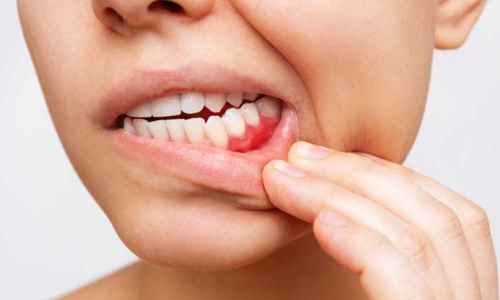 اسباب التهاب الاسنان واللثة