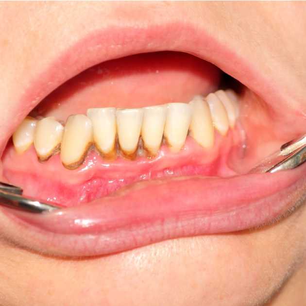 تنظيف الاسنان من الجير (1)