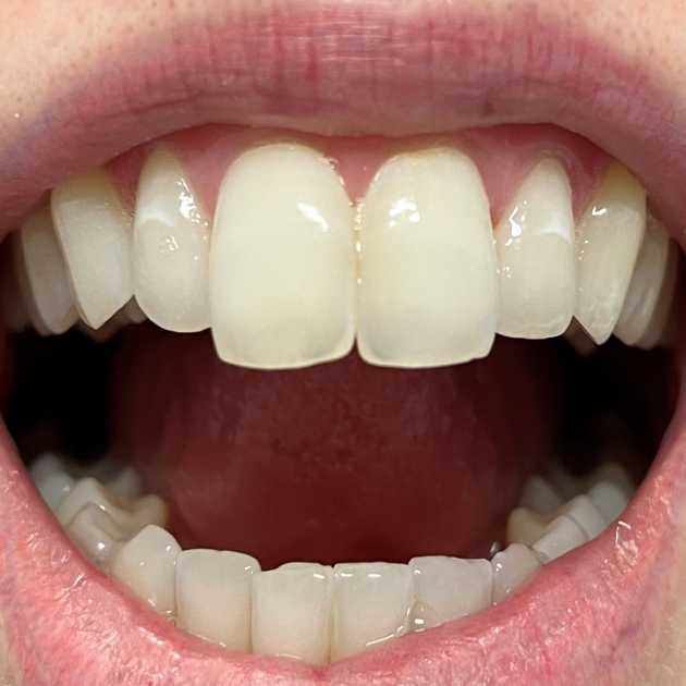 شكل الاسنان الطبيعي