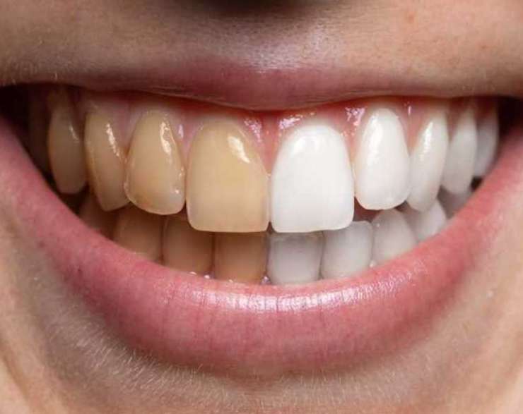 علاج اصفرار الاسنان أو تصبغات الاسنان بـ9 طرق