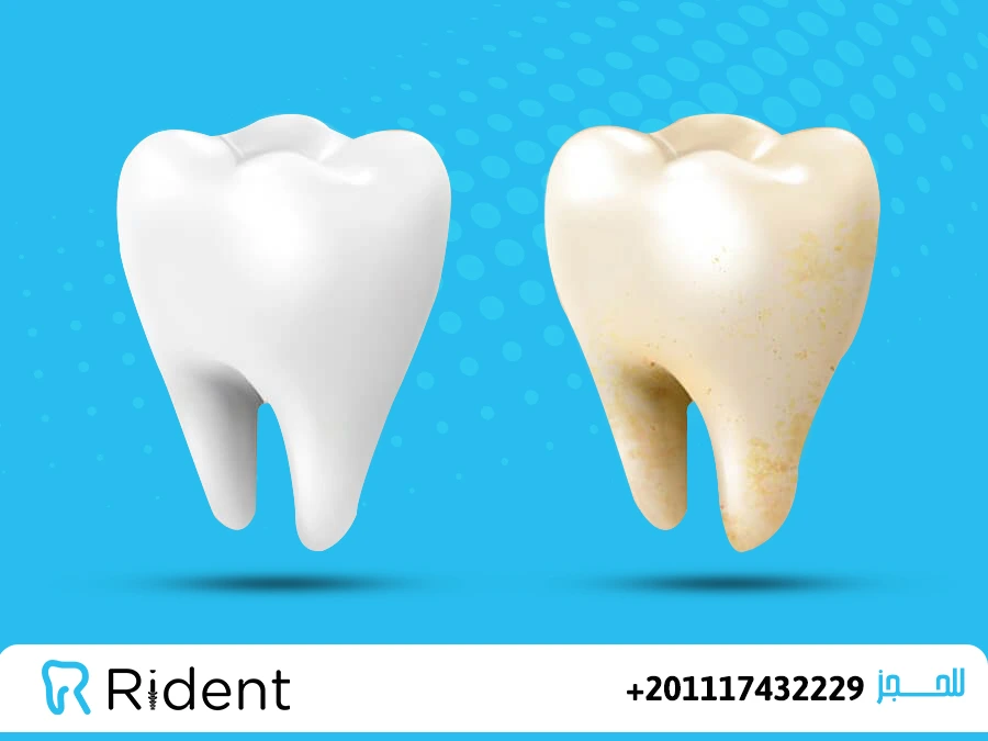 أسعار تنظيف الاسنان