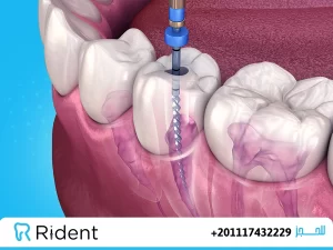 علاج الجذور