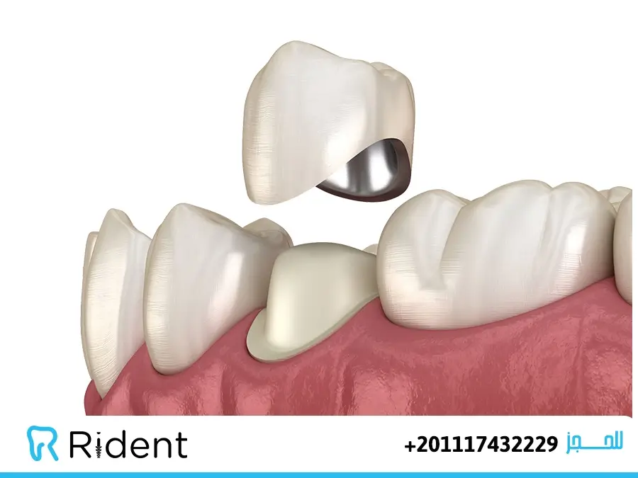 عيوب طربوش الأسنان